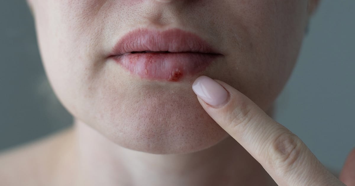 Pritelivir: la pastilla que abre una nueva puerta frente al herpes que no cedía a los tratamientos conocidos