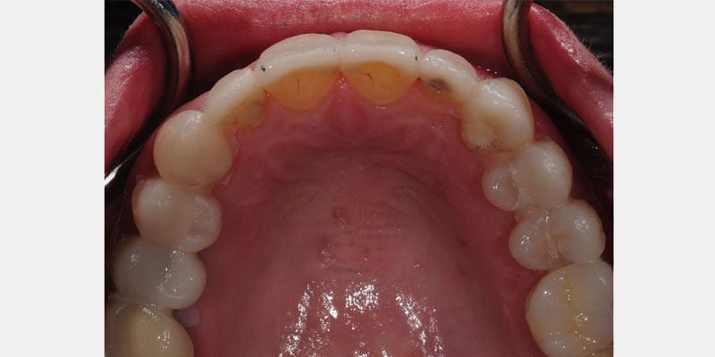 Carillas dentales: las señales de una filtración y cómo actuar a tiempo